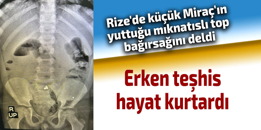 Rize'de küçük Miraç'ın yuttuğu mıknatıslı top bağırsağını deldi