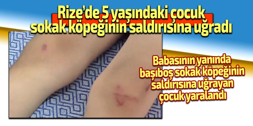 Rize’de 5 yaşındaki çocuk, sokak köpeğinin saldırısına uğradı